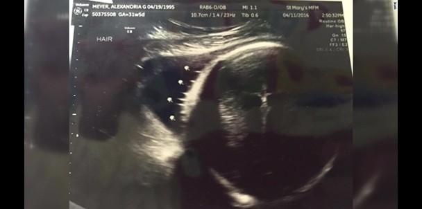 Aley Meyer Jesus Christ sonogram ultrasound